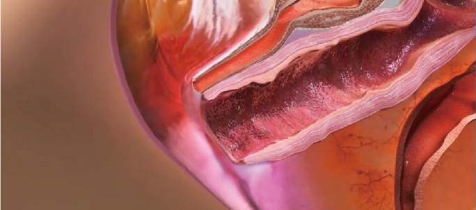 Vaginal remodeling laser_treatment