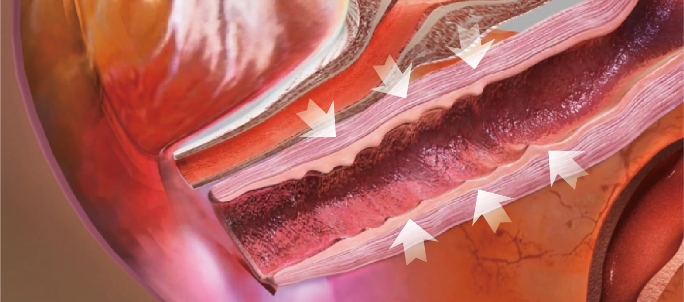 Vaginal remodeling laser_treatment