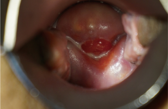 Vaginal remodeling laser_Vaginal Remodeling BA Vaginal remodeling laser_Vaginal Remodeling BA