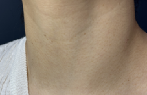 nPulse_fx-wart-removal-be co2-surgical-fractional-laser-wart-removal