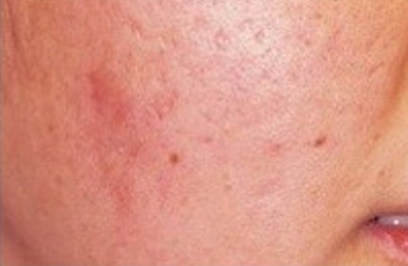 uPulse_dual-acneScar-be co2-surgical-fractional-laser-acneScar