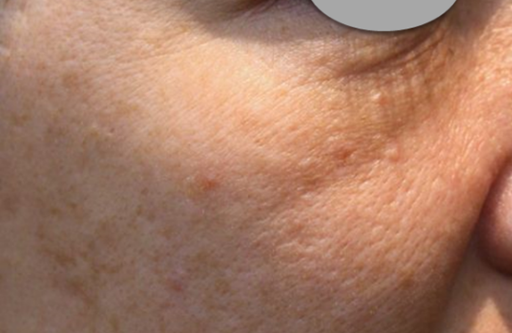 uPulse_dual-skinDepression-be co2-surgical-fractional-laser-skinDepression