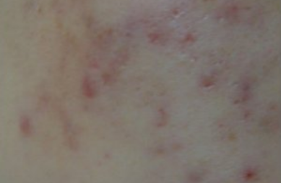 uPulse_dual-pigment-acneScar-be co2-surgical-fractional-laser-pigment-acneScar