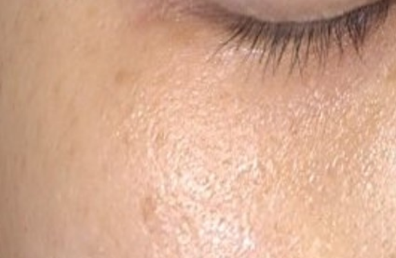 uPulse_dual-poreTightening-be co2-surgical-fractional-laser-poreTightening