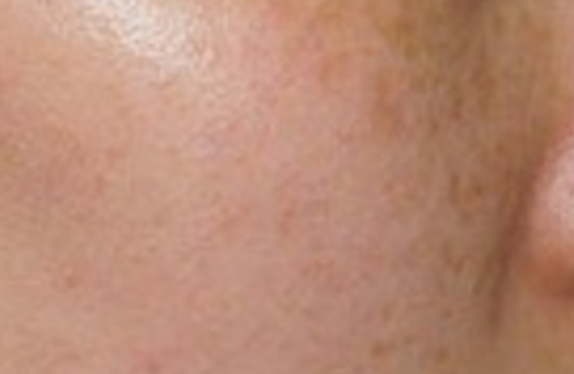 uPulse_dual-skinResurfacing-be co2-surgical-fractional-laser-skinResurfacing