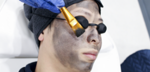 Laser Carbon Cream Peeling Treatment with Finebeam Q-Switched Nd:YAG Laser