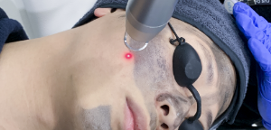 Laser Carbon Cream Peeling Treatment with Finebeam Q-Switched Nd:YAG Laser