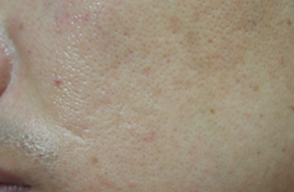 Prevent PIH, Intensive Brightening Effect