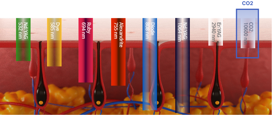 ndYag-dye-ruby-alexandrite-diode-erYag-CO2-Surgical-fractional