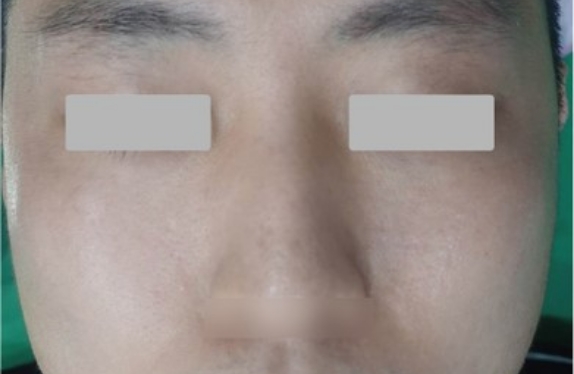 co2-surgical-fractional-laser-acneScar