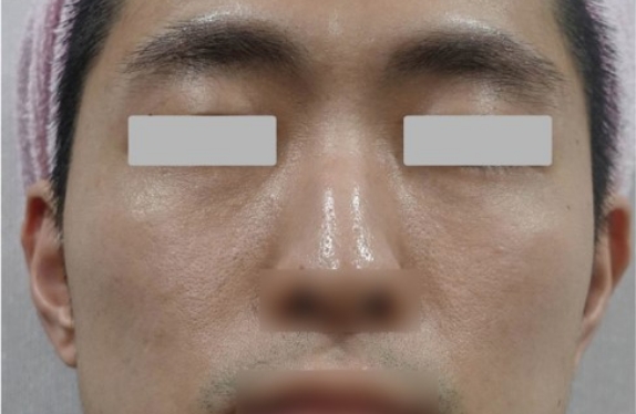 co2-surgical-fractional-laser-acneScar