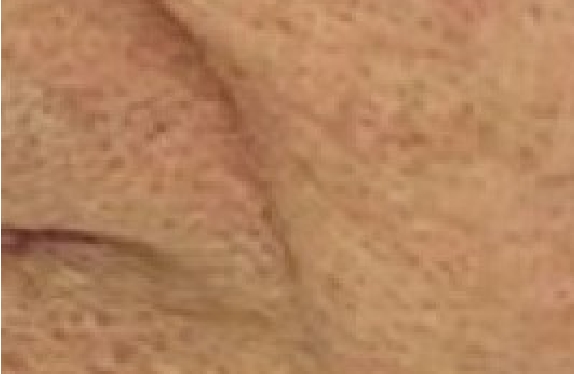 co2-surgical-fractional-laser-ageSpot