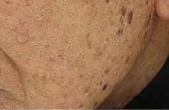 co2-surgical-fractional-laser-ageSpot