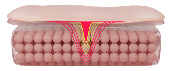 co2-surgical-fractional-laser-thermalDamage