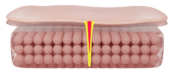 co2-surgical-fractional-laser-thermalDamage