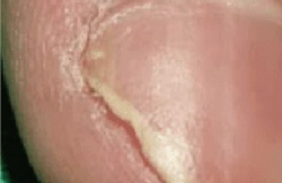 co2-surgical-fractional-laser-fingerWart