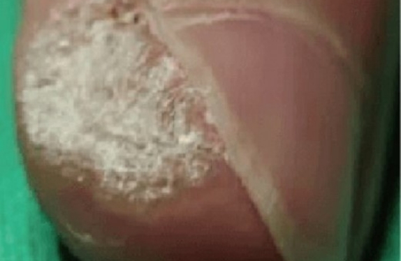 co2-surgical-fractional-laser-fingerWart