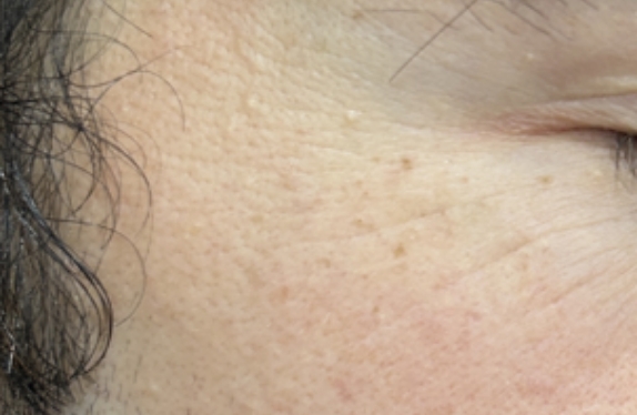 co2-surgical-fractional-laser-milium