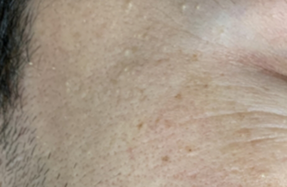 co2-surgical-fractional-laser-milium