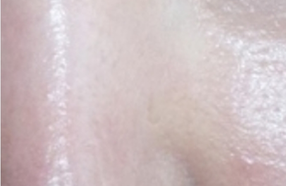 co2-surgical-fractional-laser-poreTightening