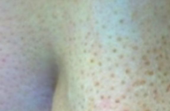 co2-surgical-fractional-laser-poreTightening