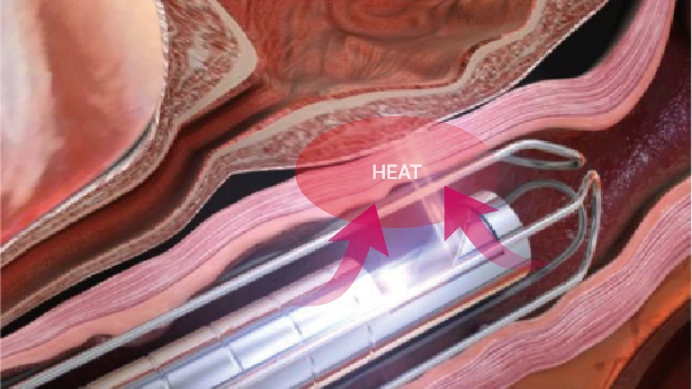 Vaginal remodeling laser_treatment