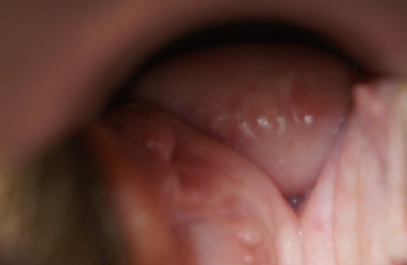 Vaginal remodeling laser_Vaginal Remodeling BA