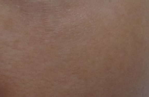 Melasma treatment with Nd:YAG laser & Dr. Lucent mask