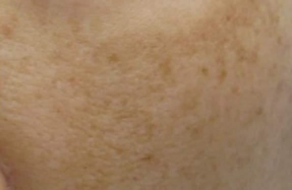 Melasma treatment with Nd:YAG laser & Dr. Lucent mask