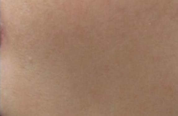 Melasma treatment with Nd:YAG laser & Dr. Lucent mask