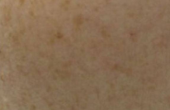 Melasma treatment with Nd:YAG laser & Dr. Lucent mask