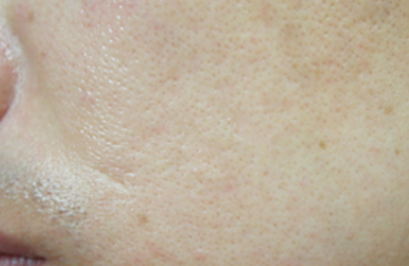 co2-surgical-fractional-laser-acne-scar
