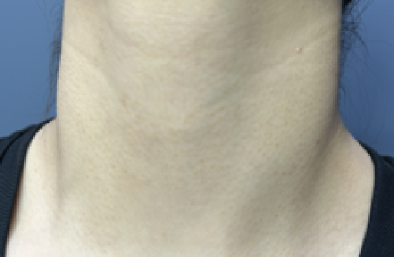 co2-surgical-fractional-laser-wart-removal