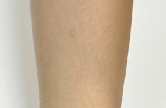 co2-surgical-laser-mole-removal