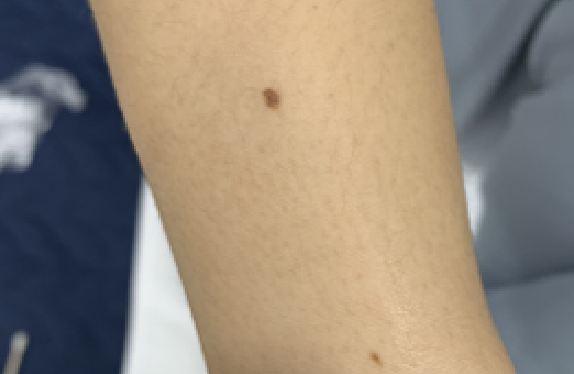 co2-surgical-laser-mole-removal