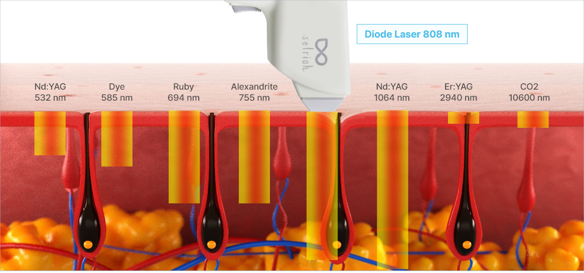 808 nm Diode Laser_Hair removal