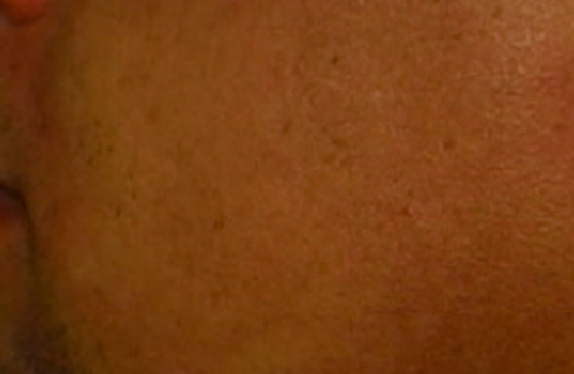 755, 808, 1064 nm Diode Laser_Hair removal