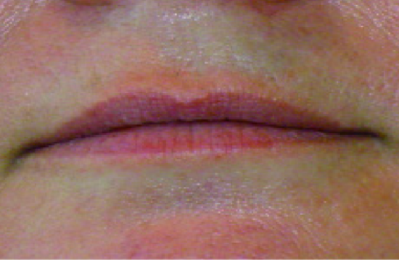 755, 808, 1064 nm Diode Laser_Hair removal