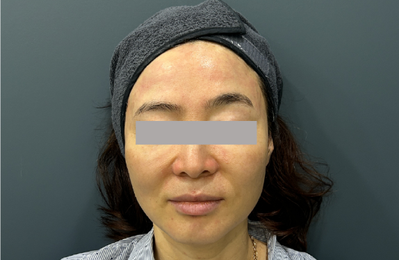 755, 808, 1064 nm Diode Laser_Lifting