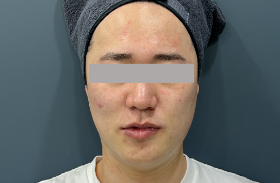 755, 808, 1064 nm Diode Laser_Lifting