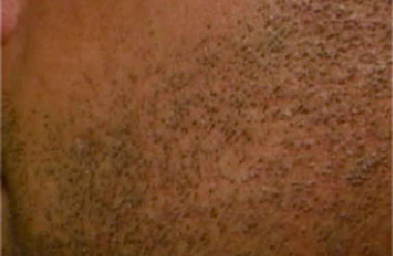 755, 808, 1064 nm Diode Laser_Hair removal