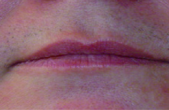 755, 808, 1064 nm Diode Laser_Hair removal