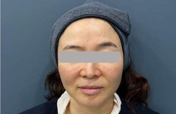 755, 808, 1064 nm Diode Laser_Lifting