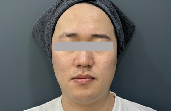 755, 808, 1064 nm Diode Laser_Lifting