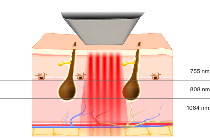 755, 808, 1064 nm Diode Laser