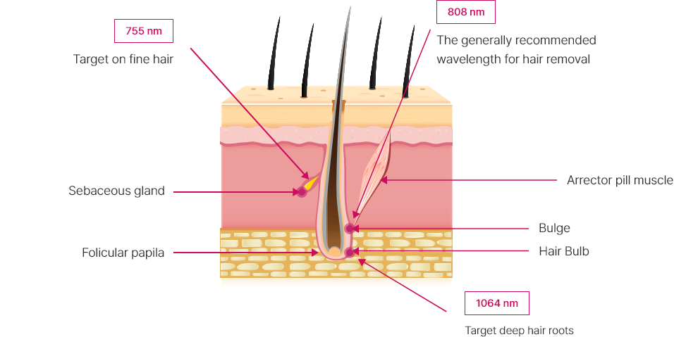 755, 808, 1064 nm Diode Laser