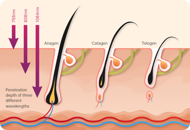 755, 808, 1064 nm Diode Laser