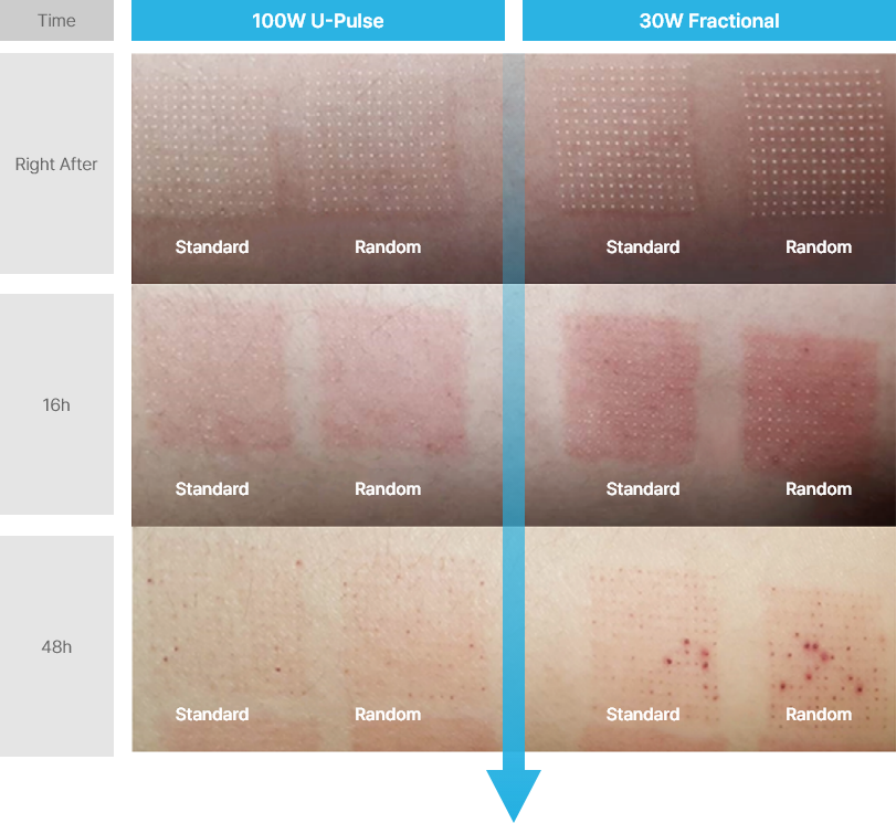 co2-surgical-fractional-laser