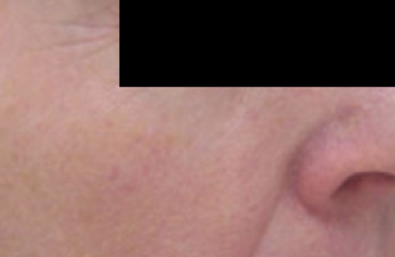co2-surgical-fractional-laser-fineWrinkleRemoval