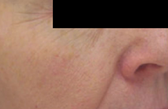 co2-surgical-fractional-laser-fineWrinkleRemoval